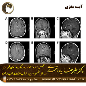 آبسه مغزی